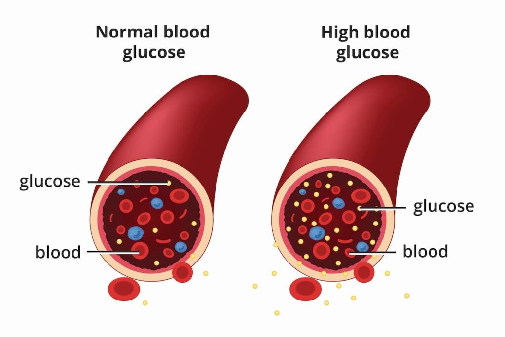 Uncovering the Real Cause of High Blood Sugar: MD/PROCESS® Solution